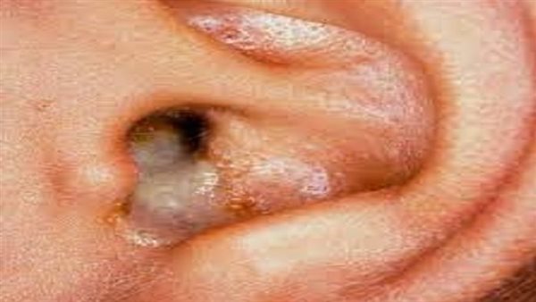 أعراض تجمع الماء