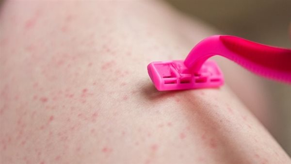 أسباب ظهور الحبوب