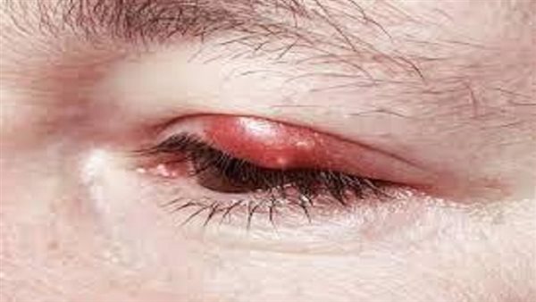 أعراض دمل العين