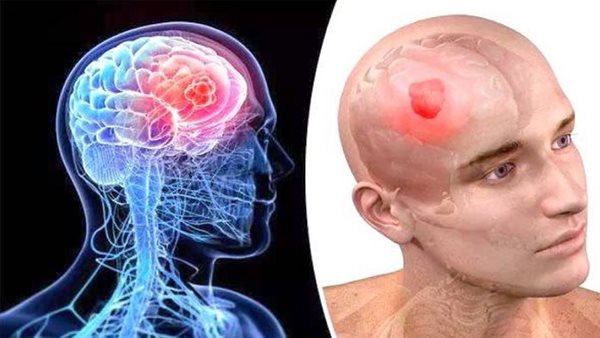 أسباب الورم الدبقي