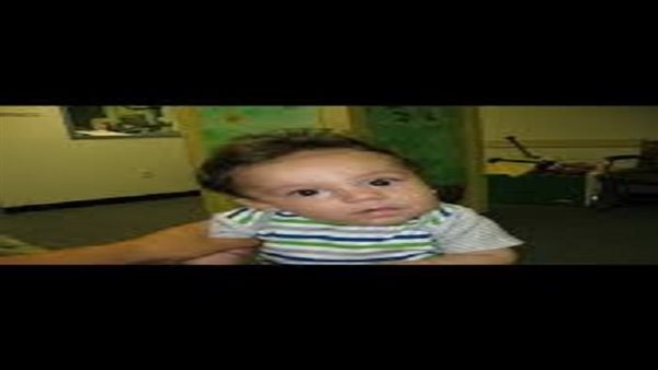 ما هي أعراض الصعر