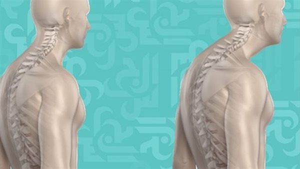 داء شويرمان.. أرشيفية