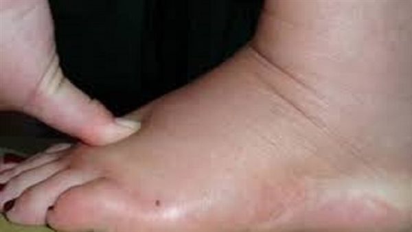 أعراض زيادة الأملاح
