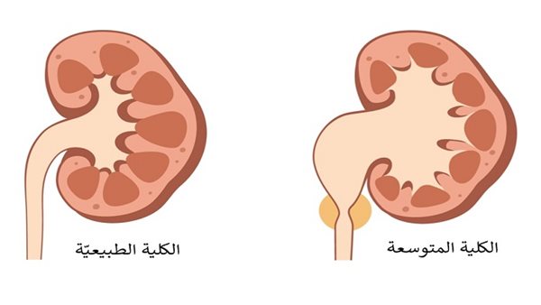 أسباب توسع حوض الكلى