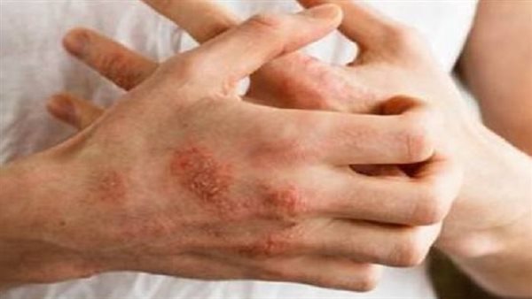أضرار عدم التعرق