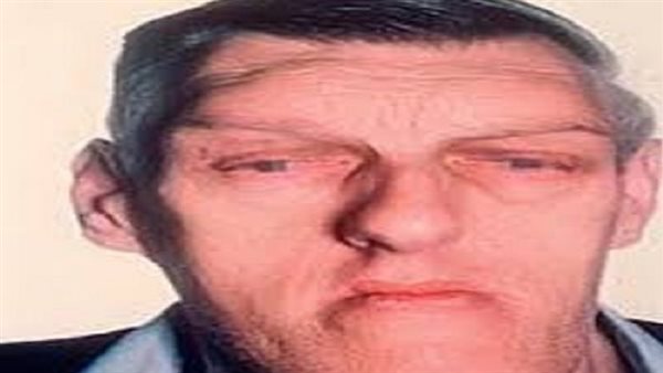 ما هي أعراض ضخامة