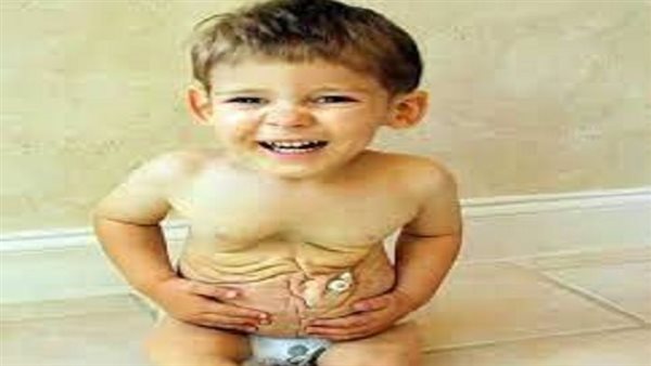 ما هي  أسباب متلازمة