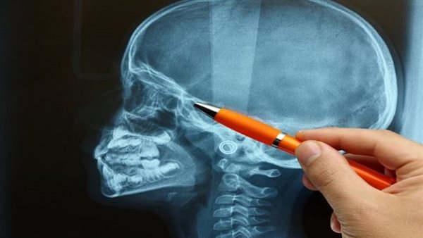 هل يوجد علاج لمتلازمة